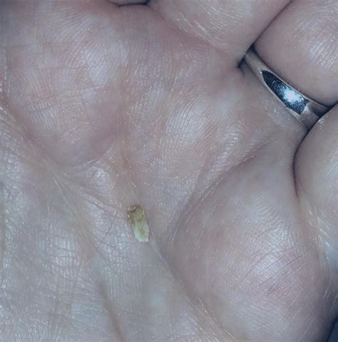 Image result for Tooth Extraction Dry Socket