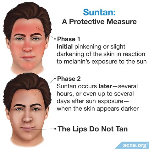Sun Tan Vs Sunburn at Fanny Payton blog