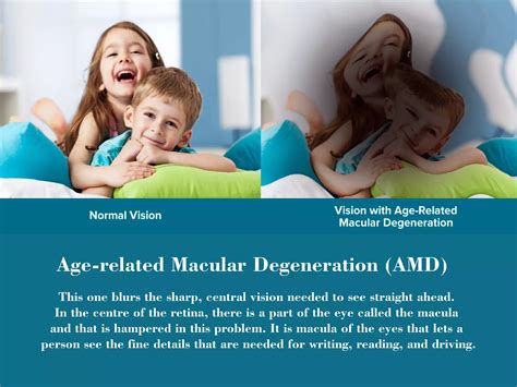 Image result for Types of Vision Problems