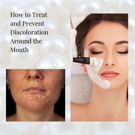 Causes and Treatments for Mouth Discoloration | Clinikally