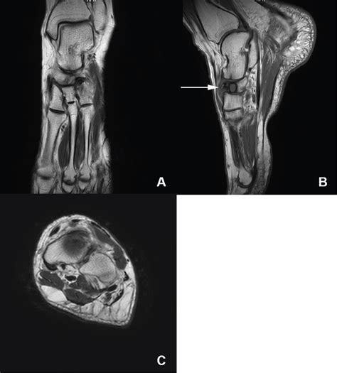 Mueller Weiss Syndrome: A Missed Cause of Mid Foot Pain