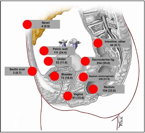Diagnostics and Surgical Treatment of Deep Endometriosis—Real-World ...