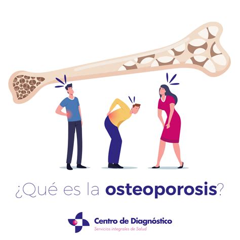 Centro de Diagnóstico | ¿Qué es la osteoporosis?