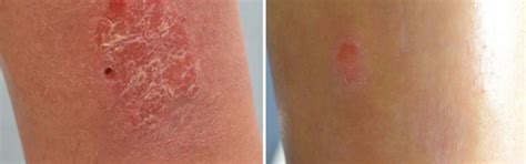 Ultra Healing Cream for Eczema Patches & Flare Ups – Oleum Cottage