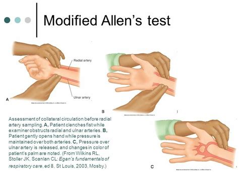 Modified Allen's Test