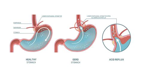 Image result for Linx Reflux Management System