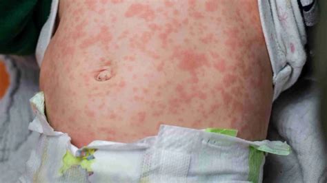 Alergias En La Piel De Los Niños Para Padres | Doctor Online