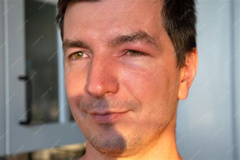 Insect Bite On Eyelid