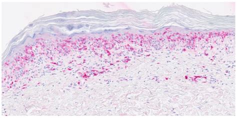 Pityriasis Lichenoides Chronica-like CD8-Positive Mycosis Fungoides
