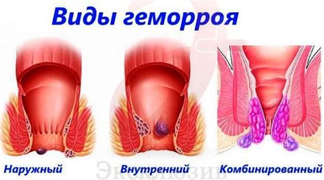 Геморрой что это такое