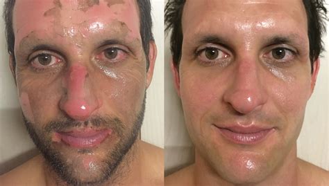 Scott’s Scarring Story - Acne Scar Treatment by DMK