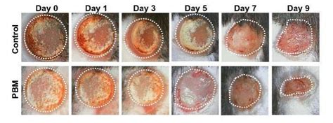 Light Therapy Can Help Heal Burn Injuries Faster By Triggering Key ...