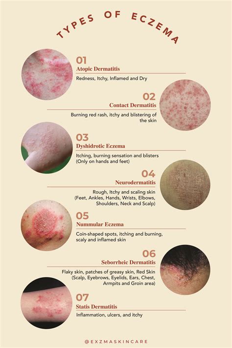 Types of eczema – Artofit