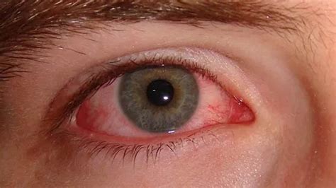 Conjunctivitis: छ्त्तीसगढ़ में हर तीसरा व्यक्ति पिंक आई फ्लू से ...
