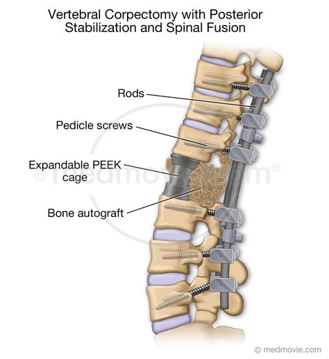 spinal stabilization technologies