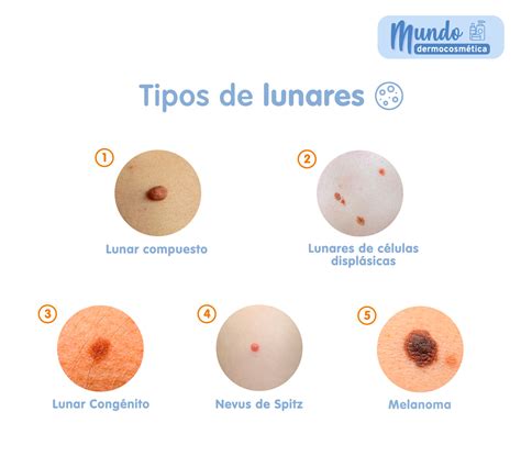 Ejemplos De Lunares Cancerosos
