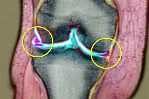 Mri Knee Medial Meniscus Tear