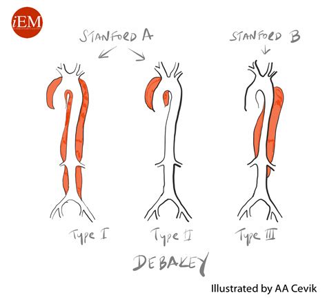 Aortic Dissection | Summary | Geeky Medics