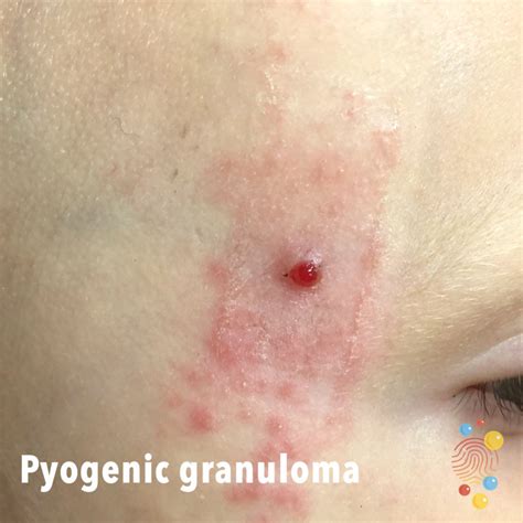 Pyogenic Granuloma Nose