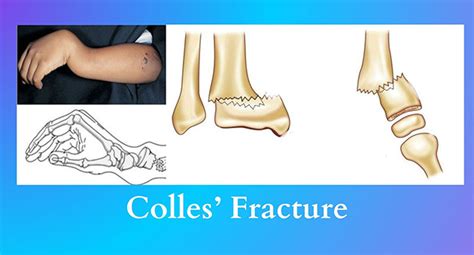 Colles’ Fracture | SAKSHAM LMIS - NIHFW