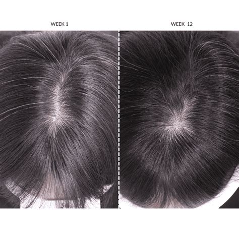 LED Hair Growth Helmet | Red Light Therapy for Hair Loss | CurrentBody ...