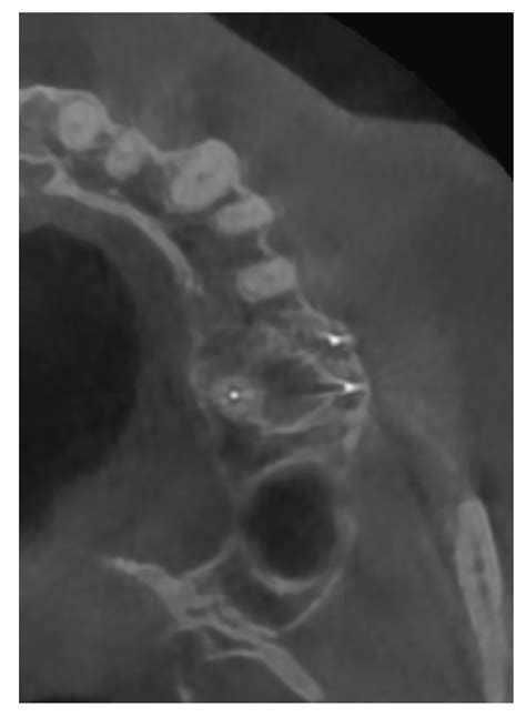 Imaging Pitfalls and Diagnostic Inhibitions in Various Advanced Head ...
