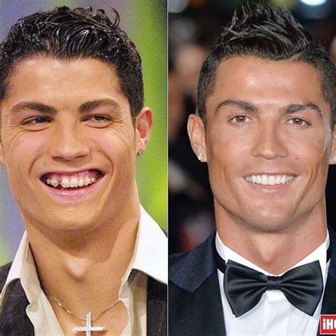 Ronaldo Before Face Surgery