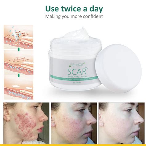 LCD Laser Skin Tag Freckle Wart Dot Mole Remove Pen | Ubuy India