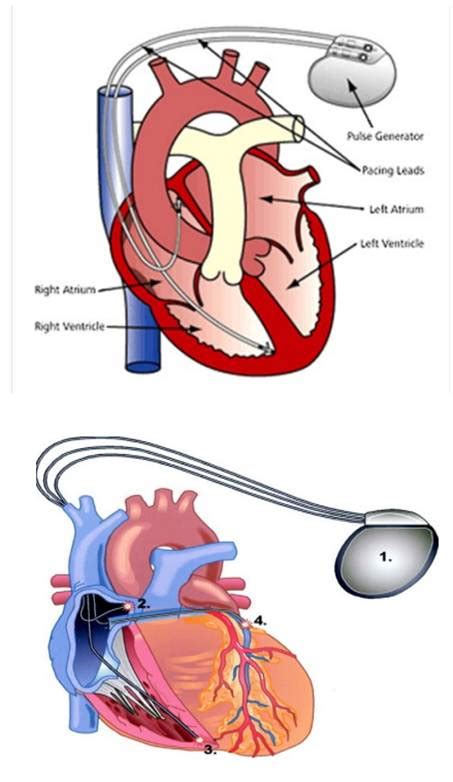 Pacemaker Procedure 的图像结果