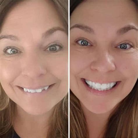 Image result for Partial Denture Procedure