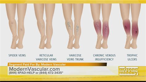Help For Your Legs with Modern Vascular | 12news.com - treat venous disease