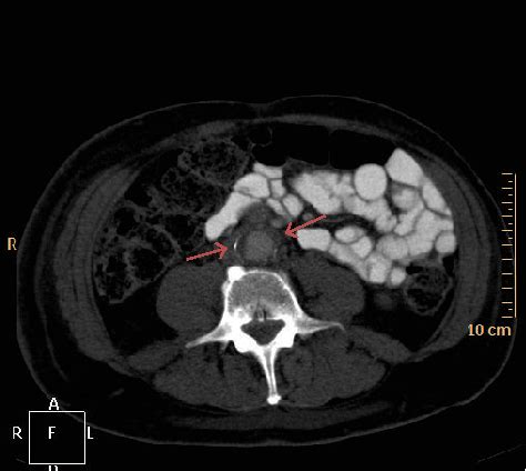 What is a pulmonary embolism, the condition that led to Catherine O’Hara’s death? | CNN