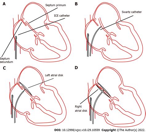 PFO Defect 的图像结果