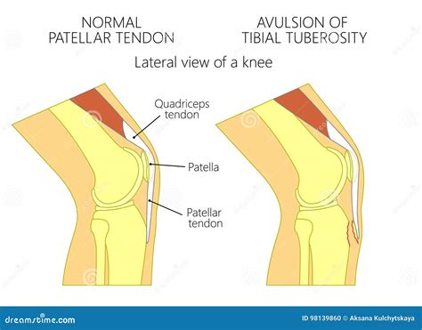Tibial Tuberosity Avulsion