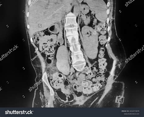 Stool In Abdomen X Ray at Marcelene Grant blog