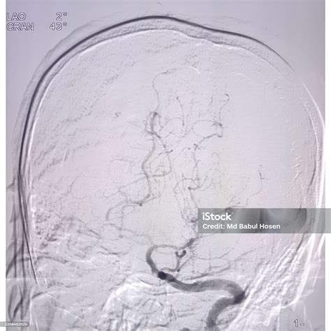 Digital Subtraction Angiography Or Cerebral Angiography Of Brain Digital Arteriogram Stock Photo ...