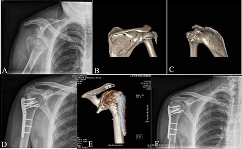 Anatomic locking plates for complex proximal humeral fractures: anatomic neck fractures versus ...