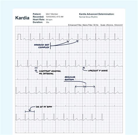 Ventricular Tachycardia Rhythm