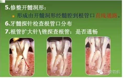 开髓术|牙体牙髓|陕西嘉友科贸有限公司