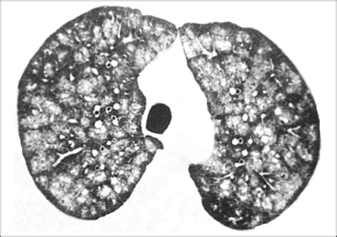 SciELO Brasil - Metastatic pulmonary calcification: high-resolution ...