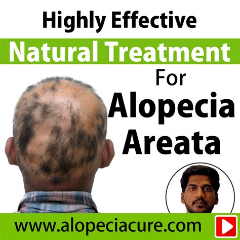 alopecia treatment review/ hair loss treatment review
