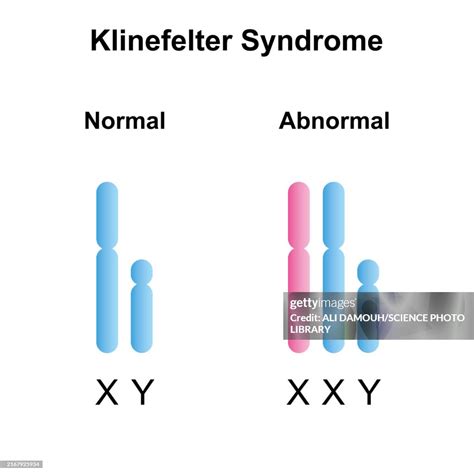 Klinefelter Syndrome Illustration High-Res Vector Graphic - Getty Images