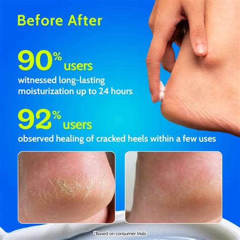 Foot cream for Cracked Heels with Amino Acid & Urea- Chemist At Play ...