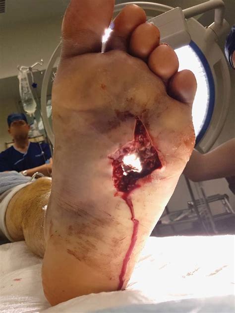shotgun injury of the left foot, pre-debridement. | Download Scientific ...
