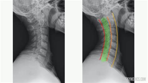 Normal Cervical Spine