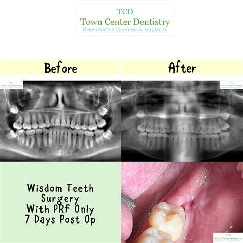 Wisdom Teeth Before And After 5 Things You Will Want To Know Before