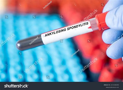 Ankylosing Spondylitis Ankylosing Spondylitis Disease Blood Stock Photo ...