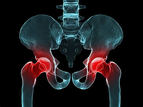 Hip Problem Pain 的图像结果