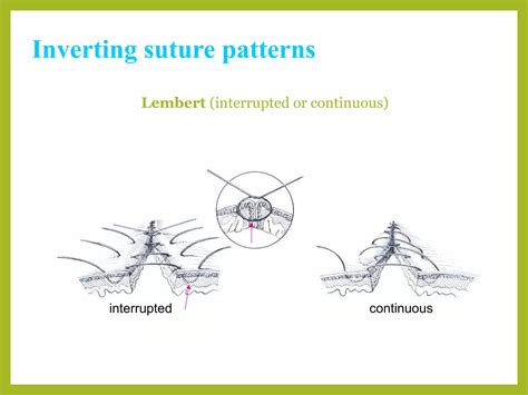 Image result for Continuous Suture Patterns