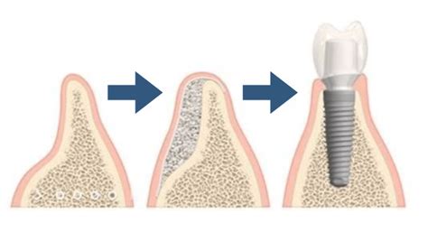 Bone graft after tooth extraction: Techniques, alternatives, healing, and more